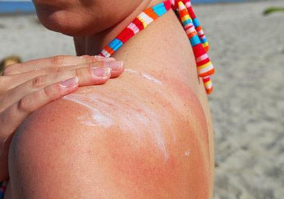 woman-sunburn-beach-remedies-410x290